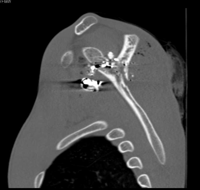 GSW Scapula and Fracture Scapula in Dialysis Patient - CTisus CT Scan