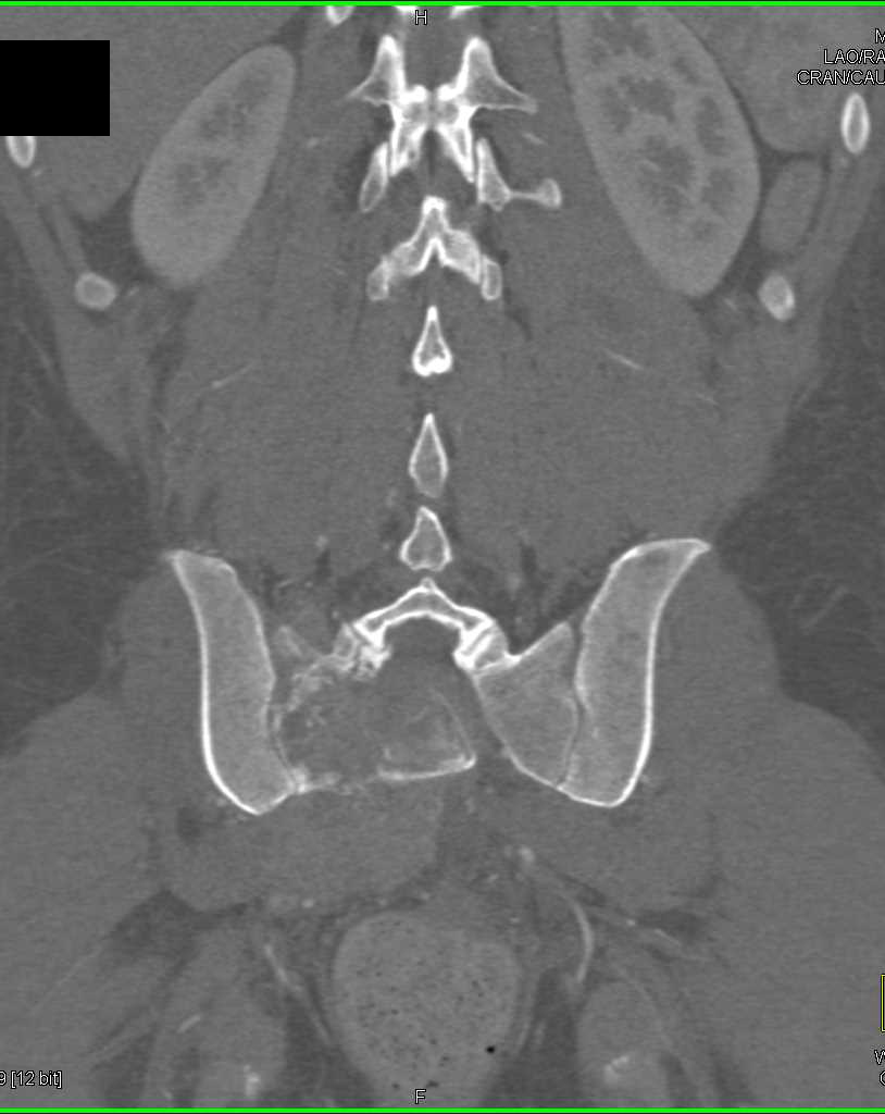 Chordoma of the Sacrum - CTisus CT Scan