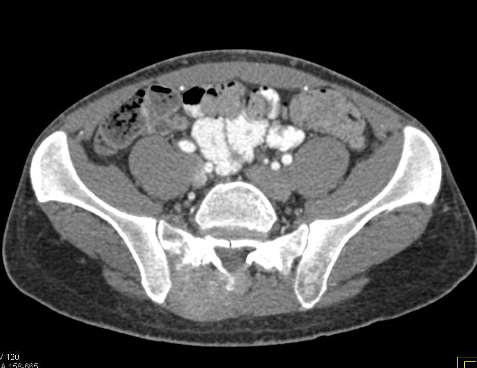 Lymphoma Infiltrates the Sacrum - CTisus CT Scan