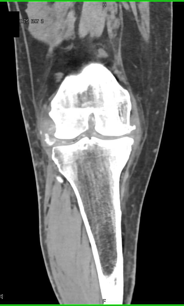 Degenerative Change with Joint Effusion - CTisus CT Scan