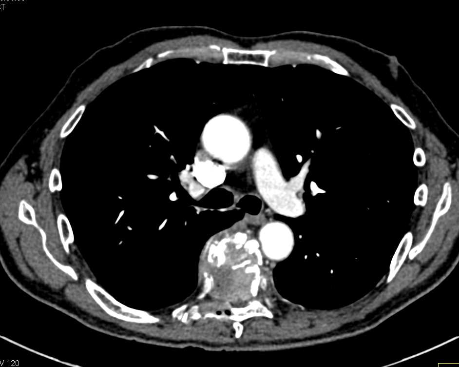 Gastric Cancer is Subtle with Metastases to the Thoracic Spine - CTisus CT Scan