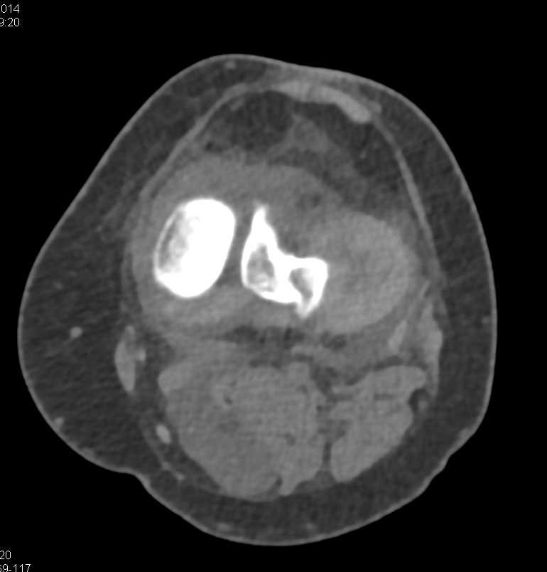 Bakers Cyst - CTisus CT Scan