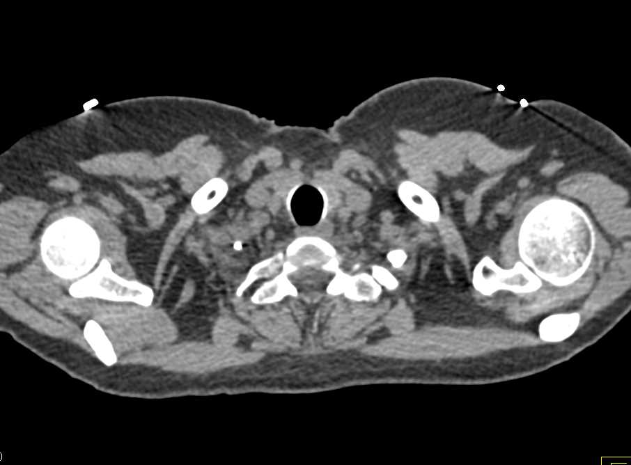 Cervical Ribs With Prior Resection on the Right Side - CTisus CT Scan