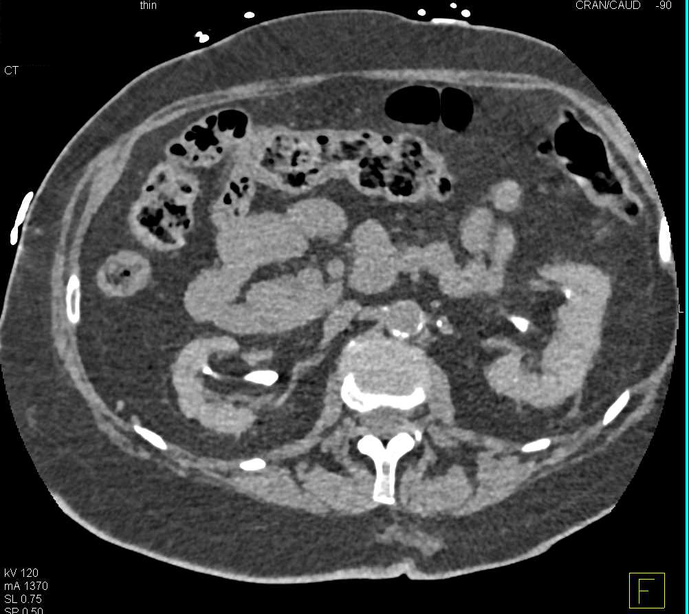 Bleed Left Groin Following Procedure - CTisus CT Scan