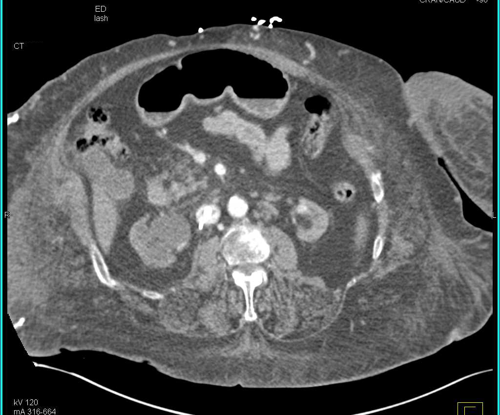 Bleed in Right Thigh - CTisus CT Scan