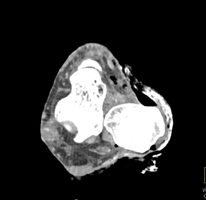 Open Fracture Dislocation of Ankle Joint - CTisus CT Scan