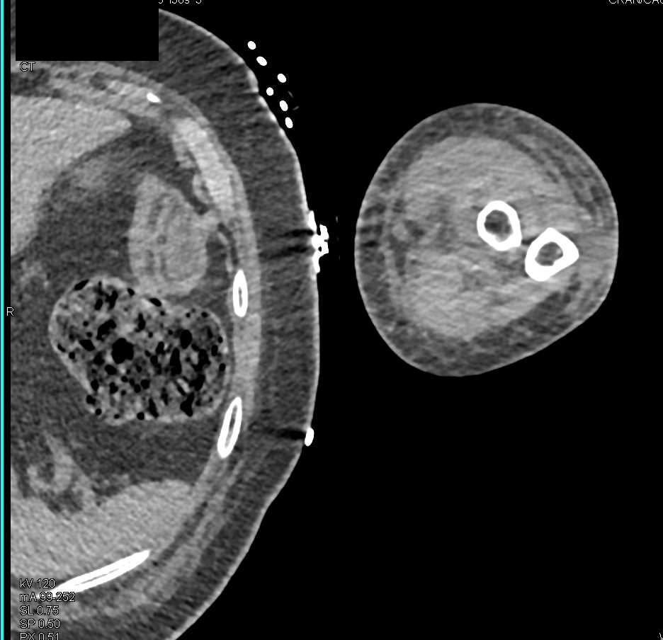 Fracture Left Elbow with Poor Healing and Alignment - CTisus CT Scan