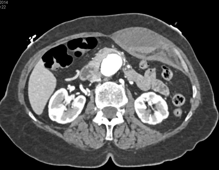 Active Bleed in the Left Rectus Muscle - CTisus CT Scan