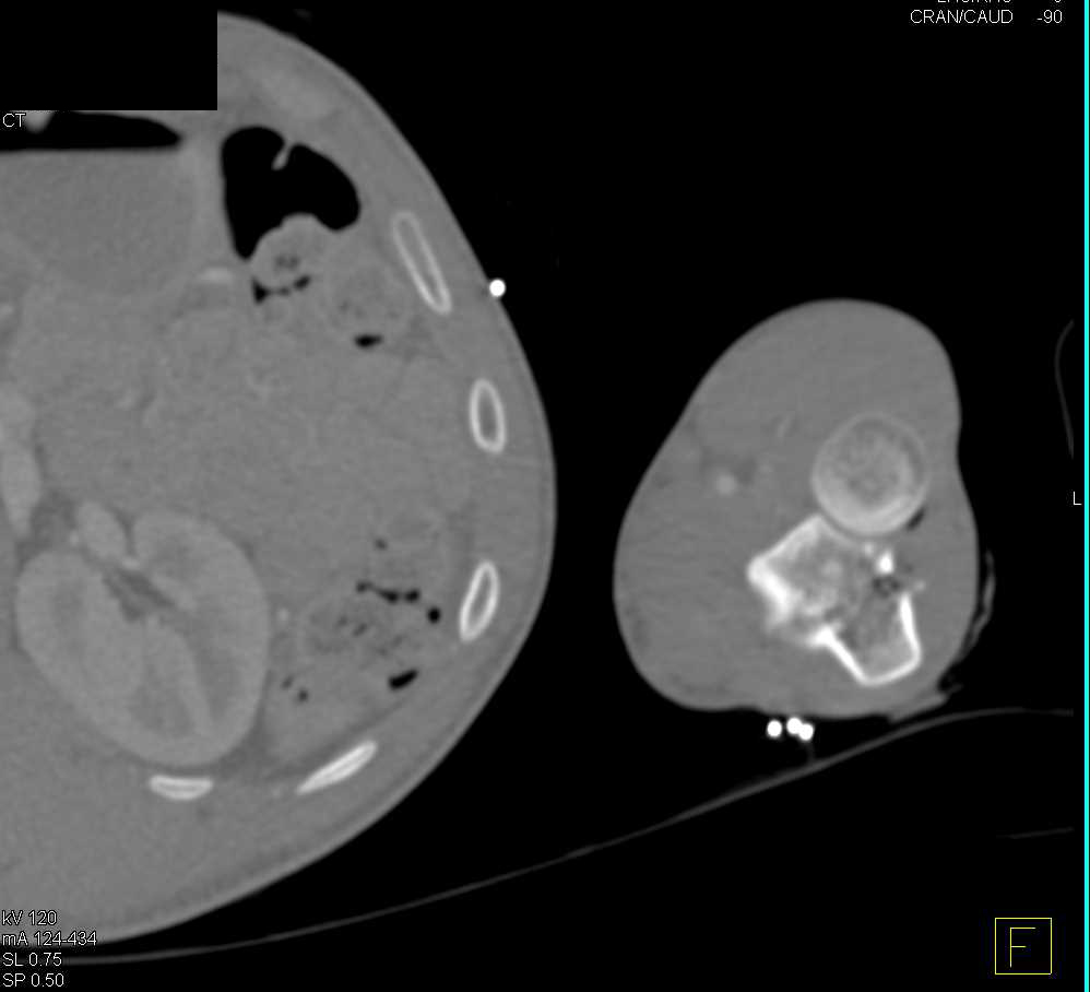 GSW with Ulna Fracture - CTisus CT Scan