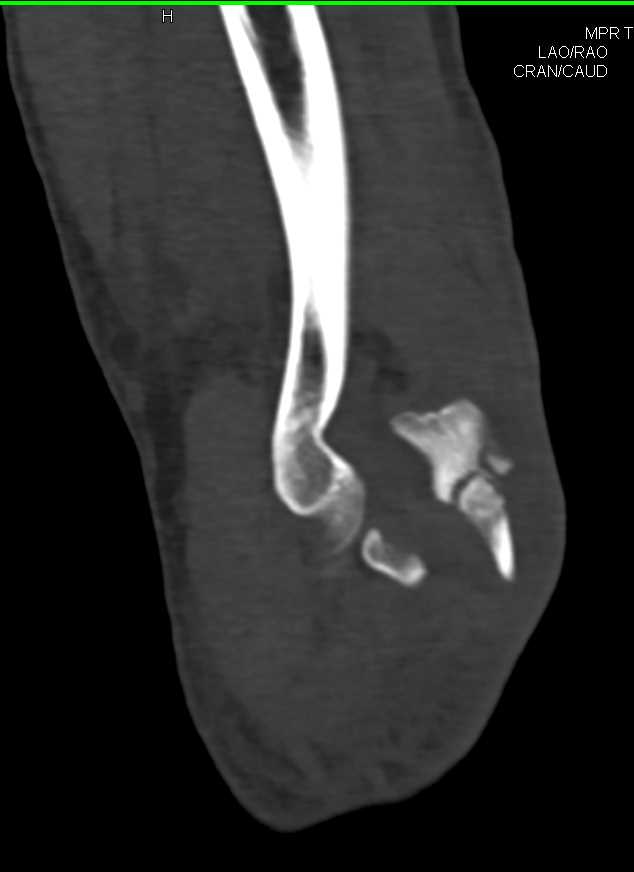 Fracture and Dislocation of the Elbow - CTisus CT Scan