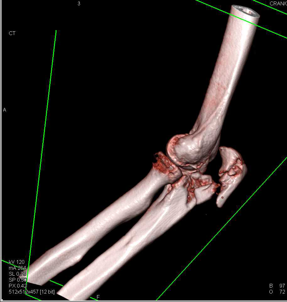 Fracture and Dislocation of the Elbow - CTisus CT Scan