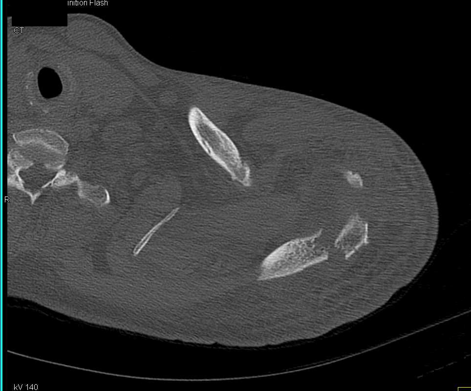 Scapular and Pelvic Fractures - CTisus CT Scan