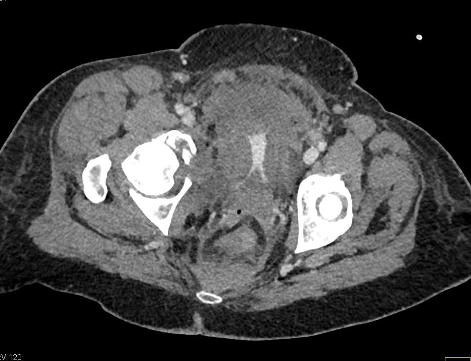 Pelvic Fractures with Splenic Bleed as Well - CTisus CT Scan