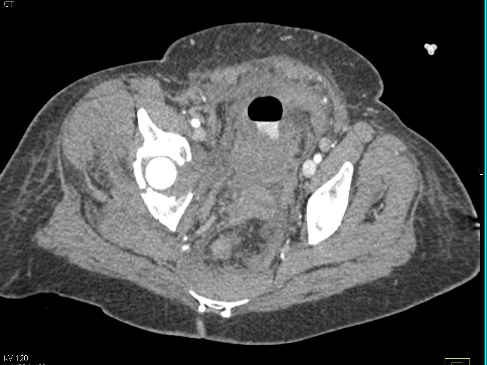 Complex Set of Fractures Pelvis - CTisus CT Scan