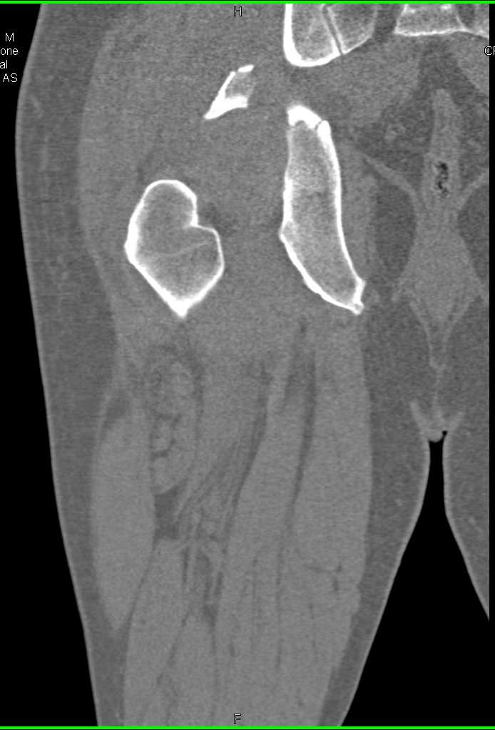 Acetabular Fracture and Dislocation of the Right Hip - CTisus CT Scan