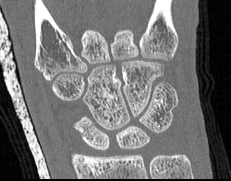 Scaphoid Fracture - CTisus CT Scan