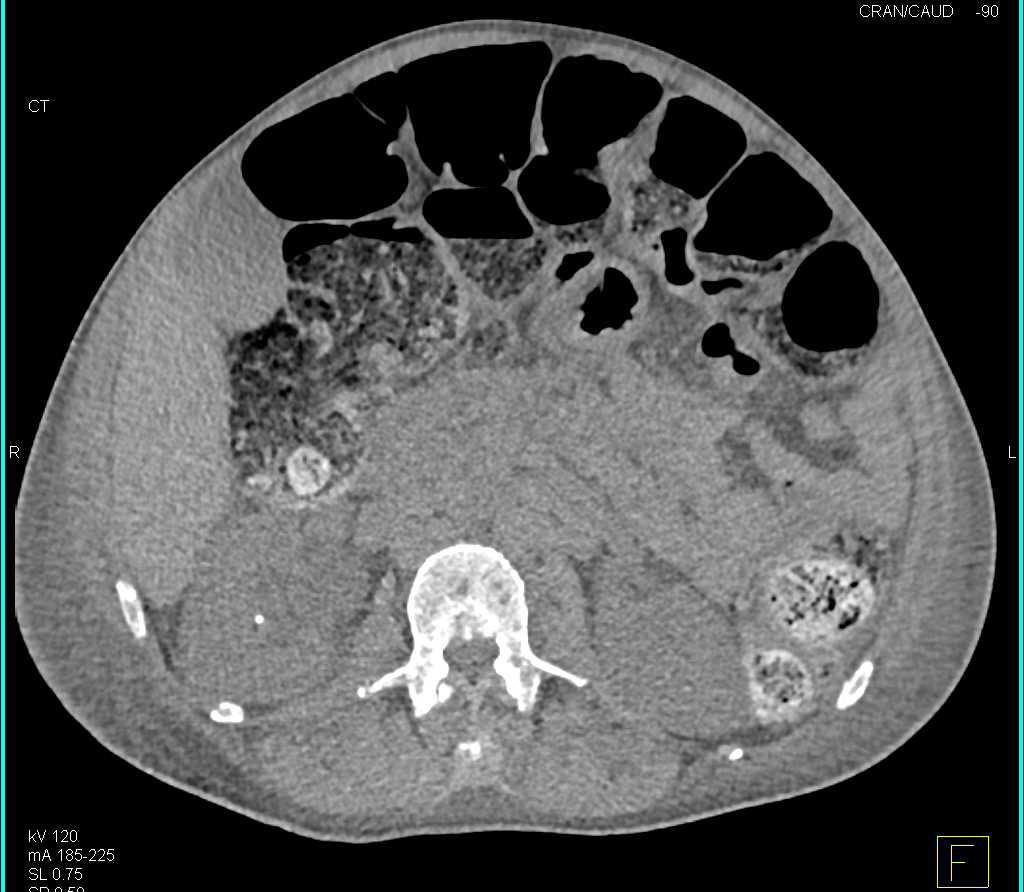 Multiple Myeloma - CTisus CT Scan