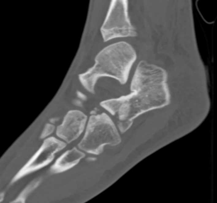 Comminuted Calcaneal Fracture - CTisus CT Scan