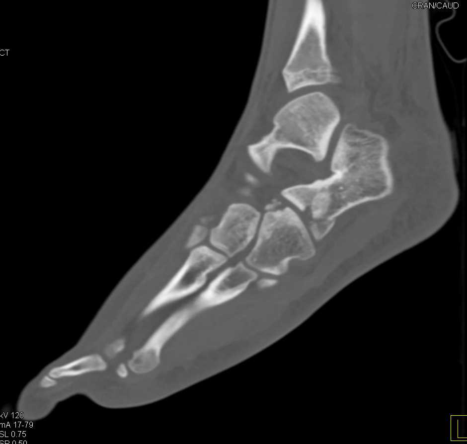 Calcaneal and Cuboid Fractures - CTisus CT Scan