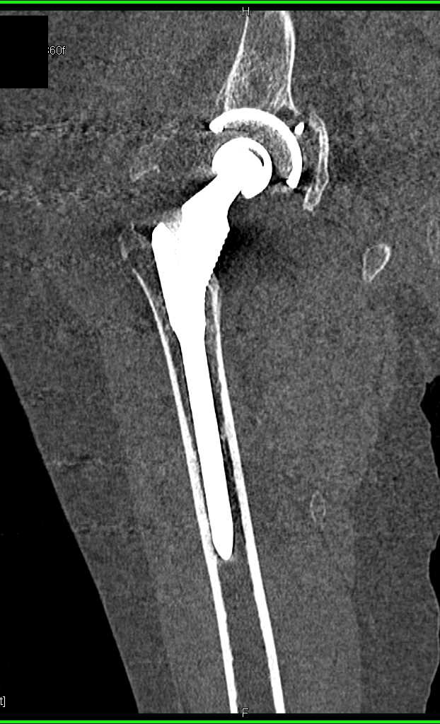 Renal Cell Carcinoma with Bone Metastases - CTisus CT Scan