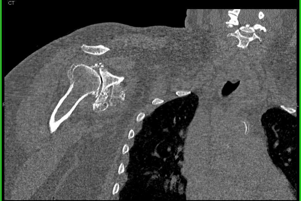 Degenerative Osteoarthritis of the Shoulder - CTisus CT Scan