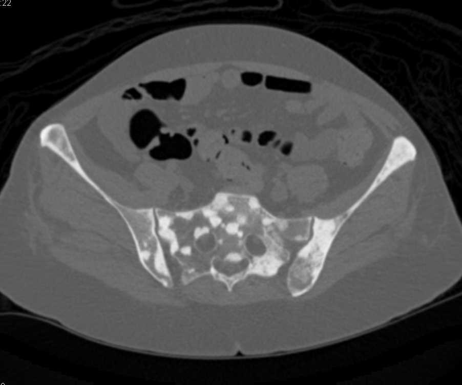 Blastic Bone Metastases from a Neuroendocrine Tumor - Musculoskeletal ...