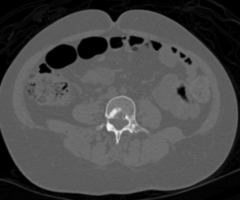 Blastic Bone Metastases from a Neuroendocrine Tumor - CTisus CT Scan