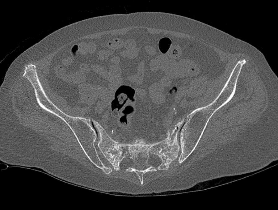 Stress Fractures Sacrum and Symphysis - CTisus CT Scan