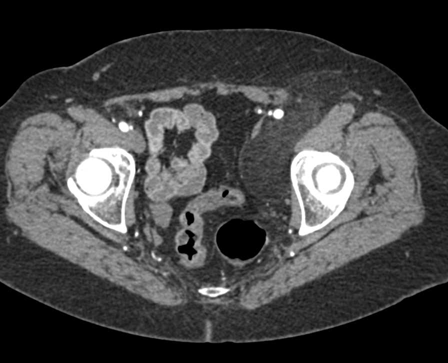 Low Grade Liposarcoma Left Thigh and Pelvis - Musculoskeletal Case ...