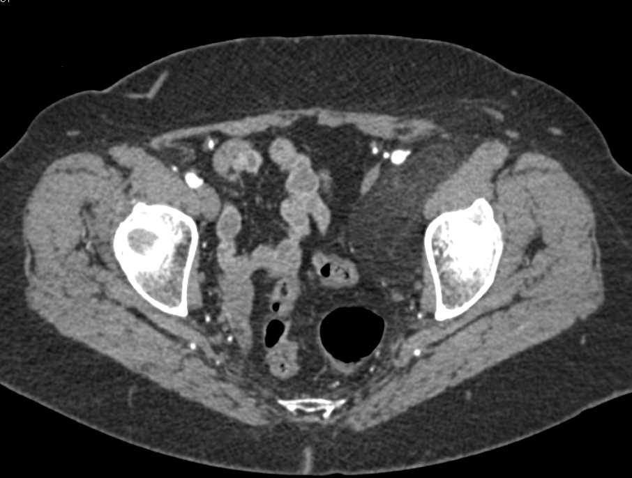 Low Grade Liposarcoma Left Thigh and Pelvis - CTisus CT Scan