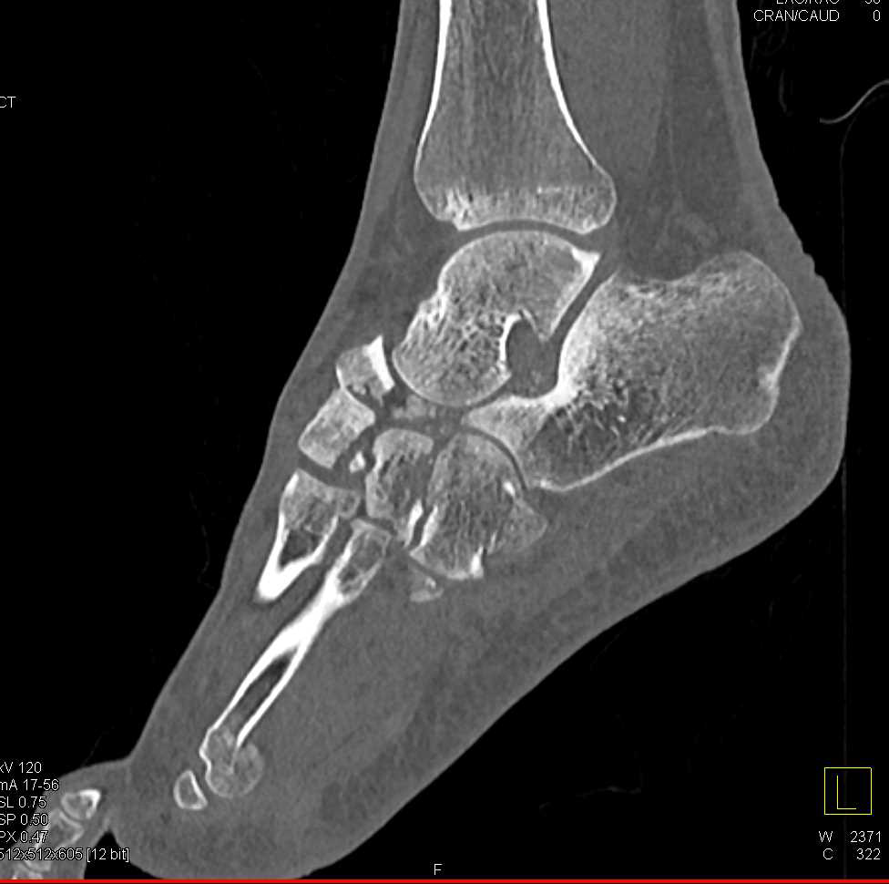 Multiple Midfoot Fractures and Dislocation - CTisus CT Scan