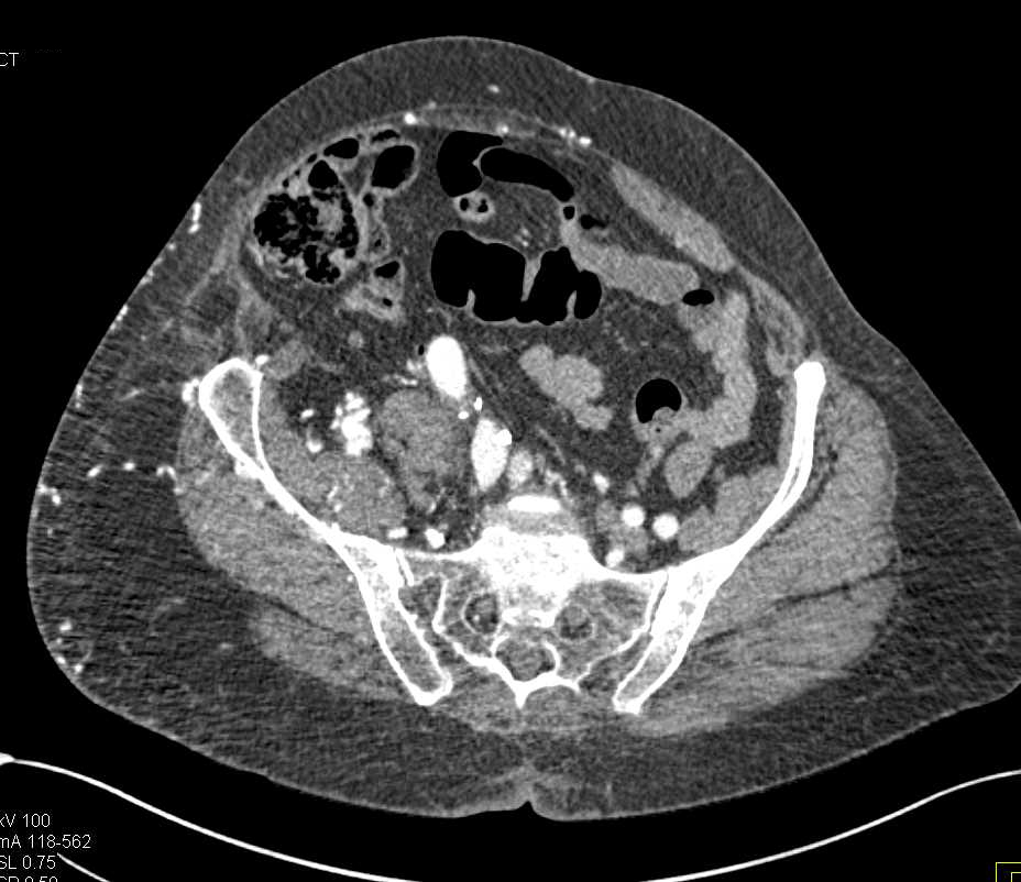 Enlarged Thigh with Multiple Arteriovenous Malformations (AVMs) - CTisus CT Scan