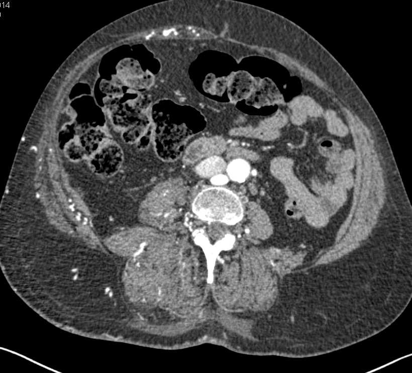 Enlarged Thigh with Arteriovenous (AV) Shunting and Arteriovenous Malformations (AVMs) - CTisus CT Scan