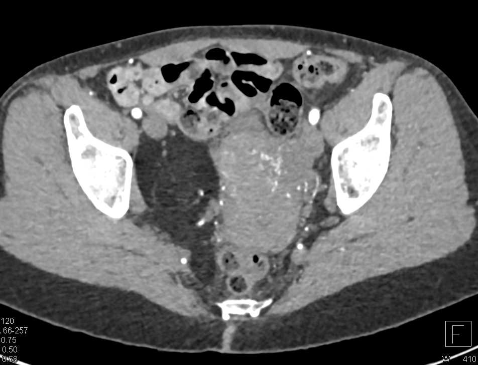 Liposarcoma Pelvis - CTisus CT Scan