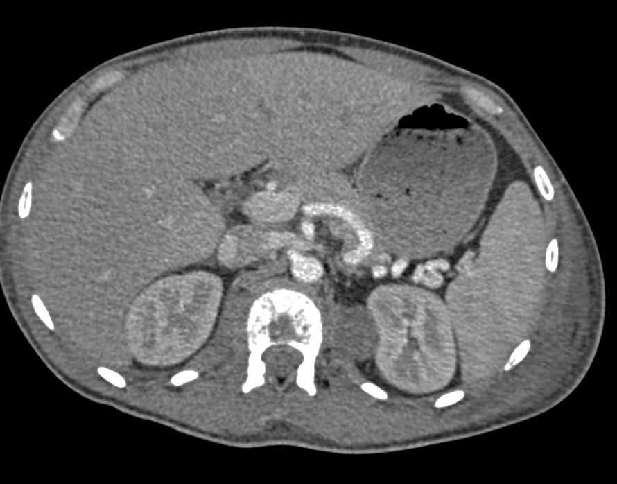 Sarcoma with Bone and Muscle Metastases - CTisus CT Scan