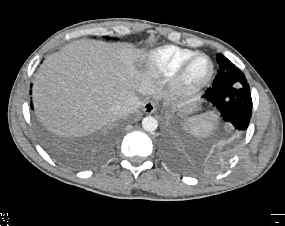 Metastatic Small Cell Carcinoma to Muscle and Bone - CTisus CT Scan