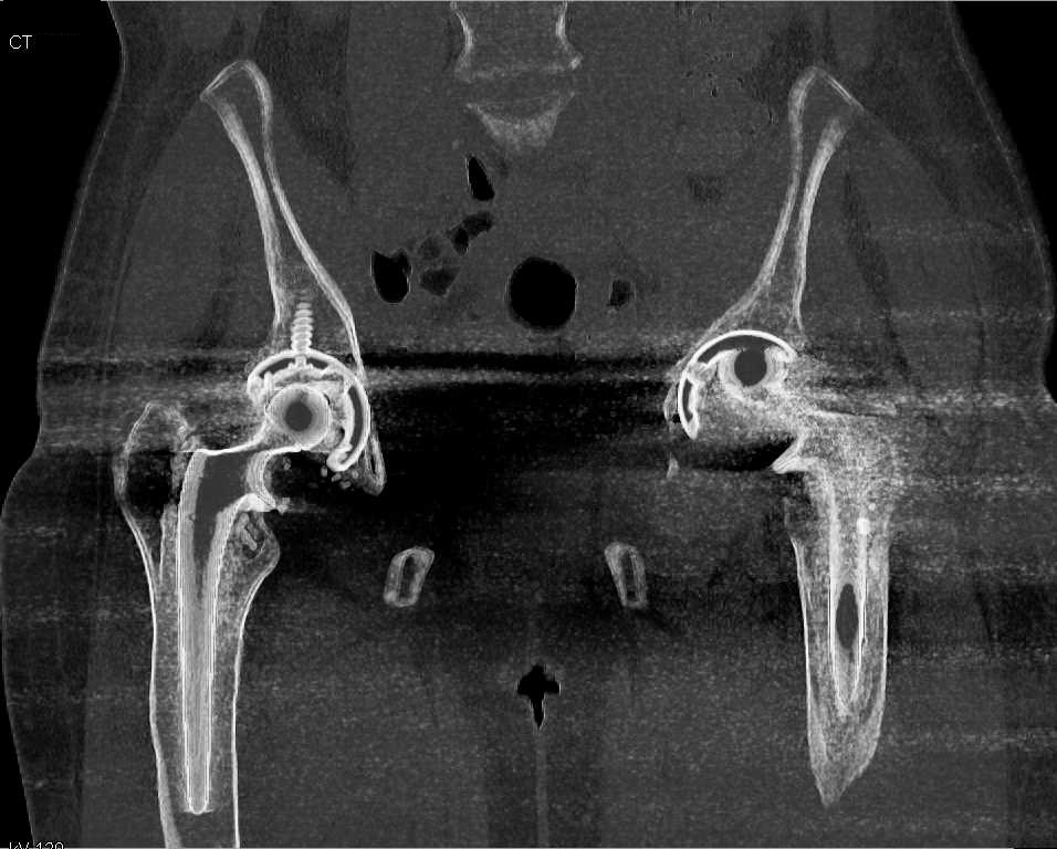 Failed Left Total Hip Replacesment - CTisus CT Scan