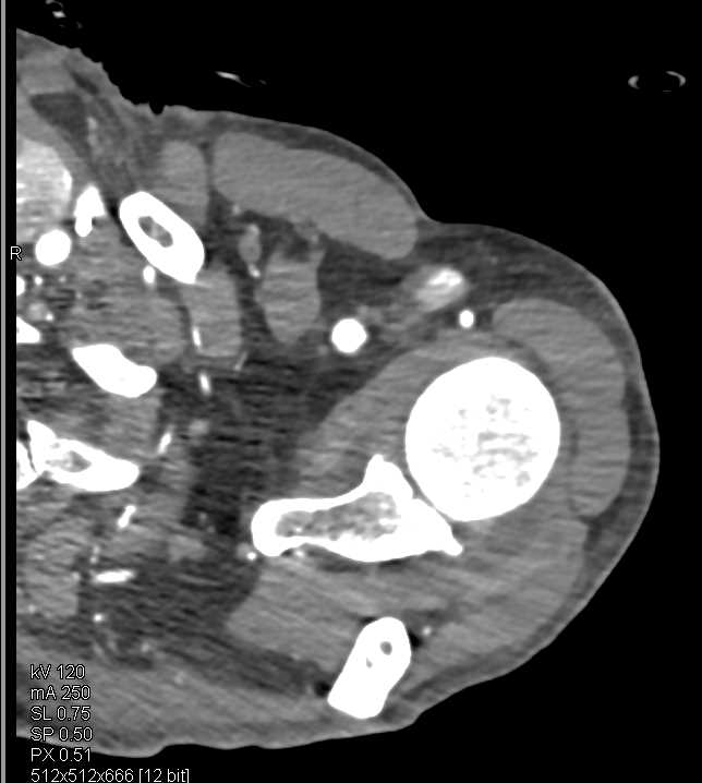 Arteriovenous (AV) Fistulae in Dialysis Patient - CTisus CT Scan