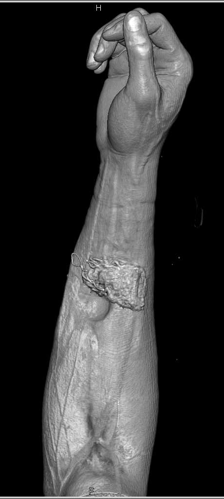 Ulnar Occlusion in Case of Vascular Trauma - CTisus CT Scan