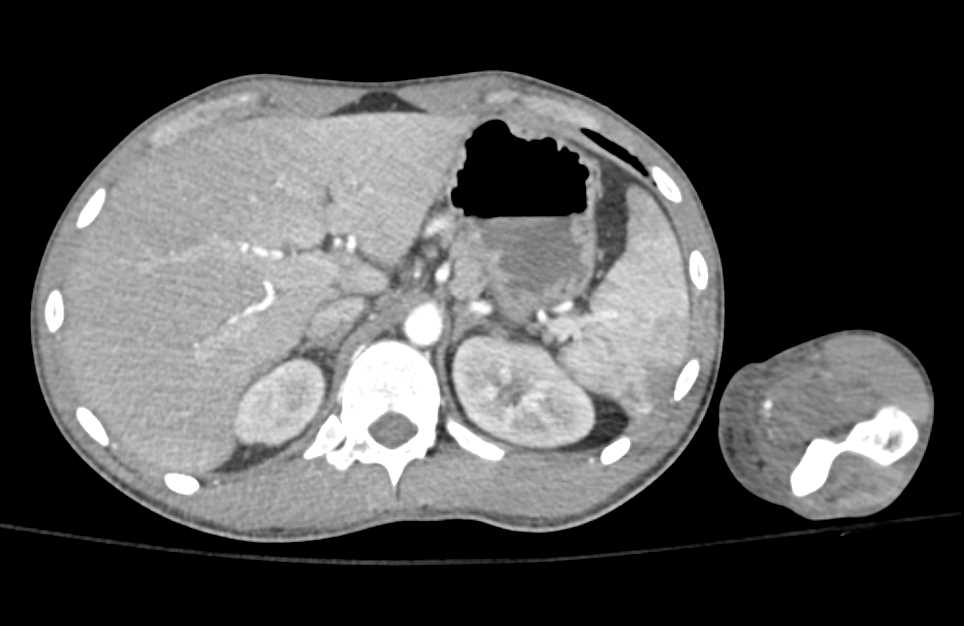 Trauma with No Contrast Extravasation from the Arm - CTisus CT Scan