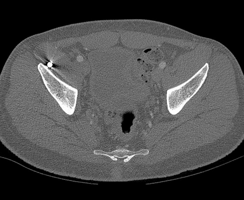 Abscess in Left Medial Buttocks - CTisus CT Scan