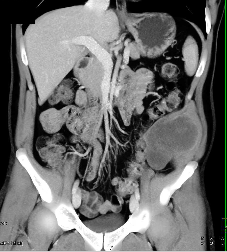 Liposarcoma Involves Abdominal Wall - CTisus CT Scan