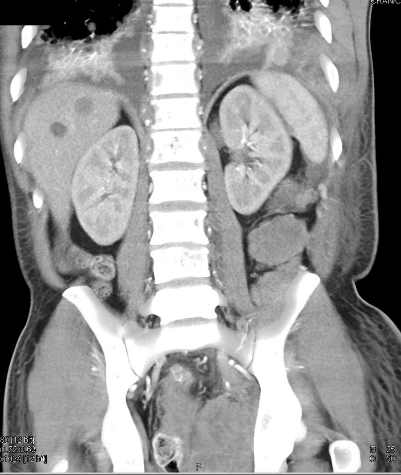 Neurosarcoma Invades the Pelvis - CTisus CT Scan