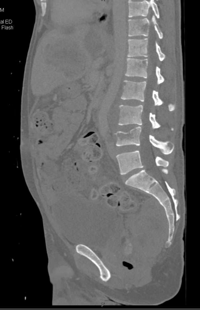 Neurosarcoma Invades the Pelvis and Multiple Bone Lesions - CTisus CT Scan