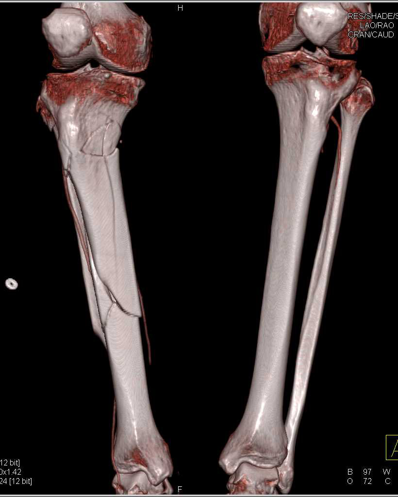 Multiple Fractures in 3D - CTisus CT Scan