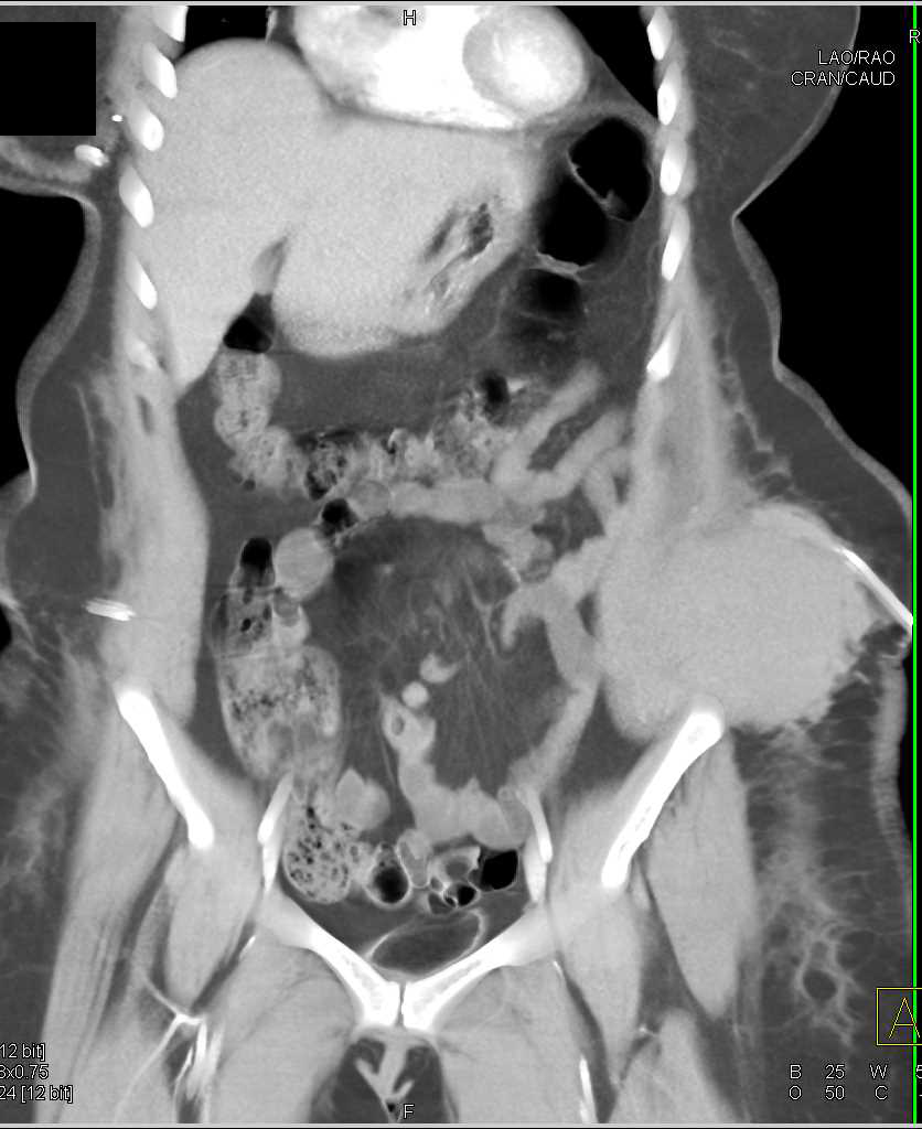 Bleed in Abdominal Wall - CTisus CT Scan