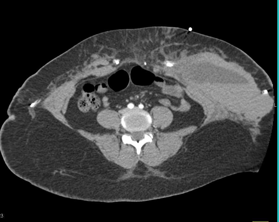 Bleed in Abdominal Wall with Blood-Fluid Level - CTisus CT Scan