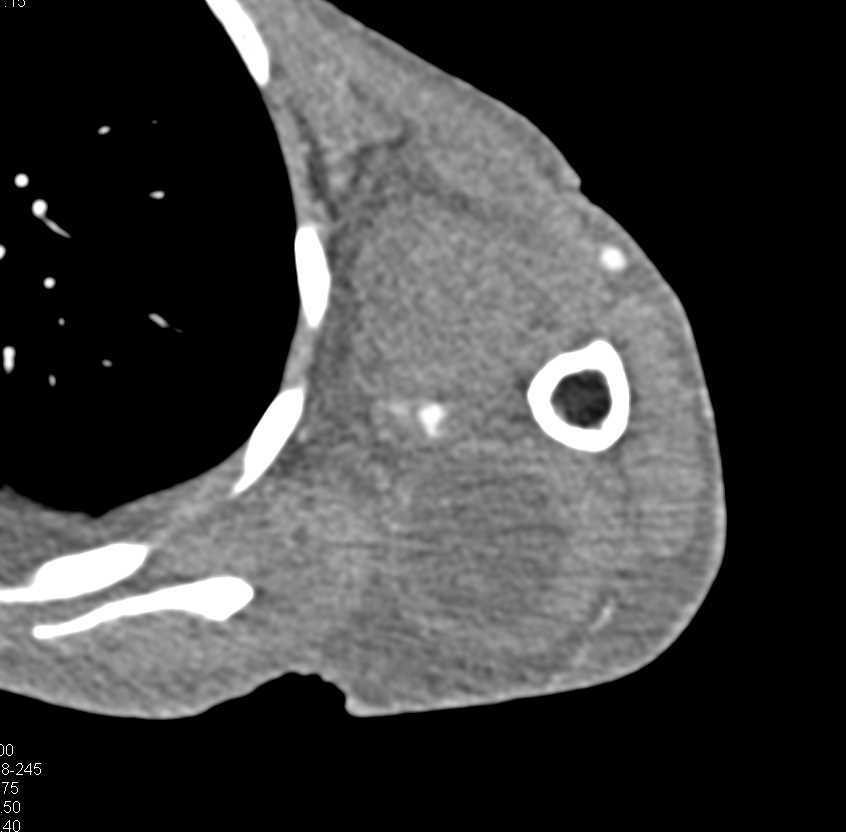 Abscess in the Left Shoulder Muscles - CTisus CT Scan