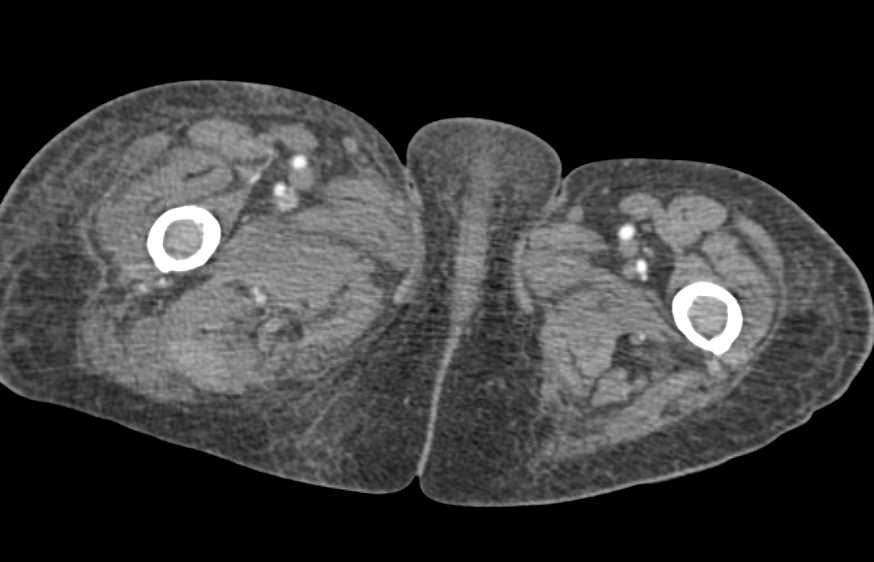 Bleed in the Right Thigh - CTisus CT Scan