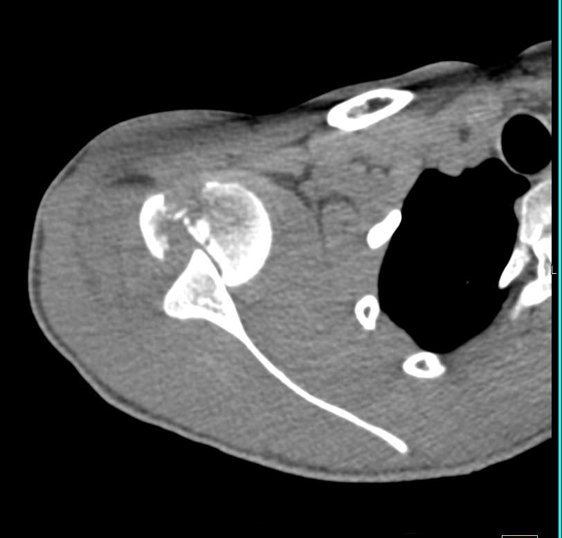 Fracture Dislocation Right Shoulder - CTisus CT Scan